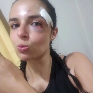 black eye after fight